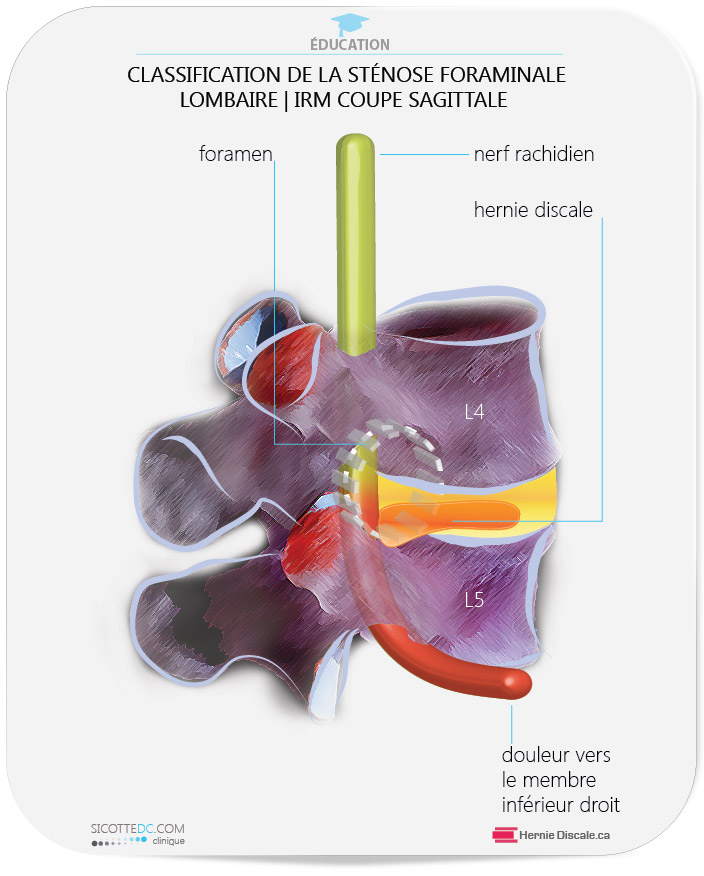 Sténose Foraminale Lombaire, Spondylolisthésis ou Antérolisthésis Sténose Foraminale Lombaire, Spondylolisthésis ou Antérolisthésis