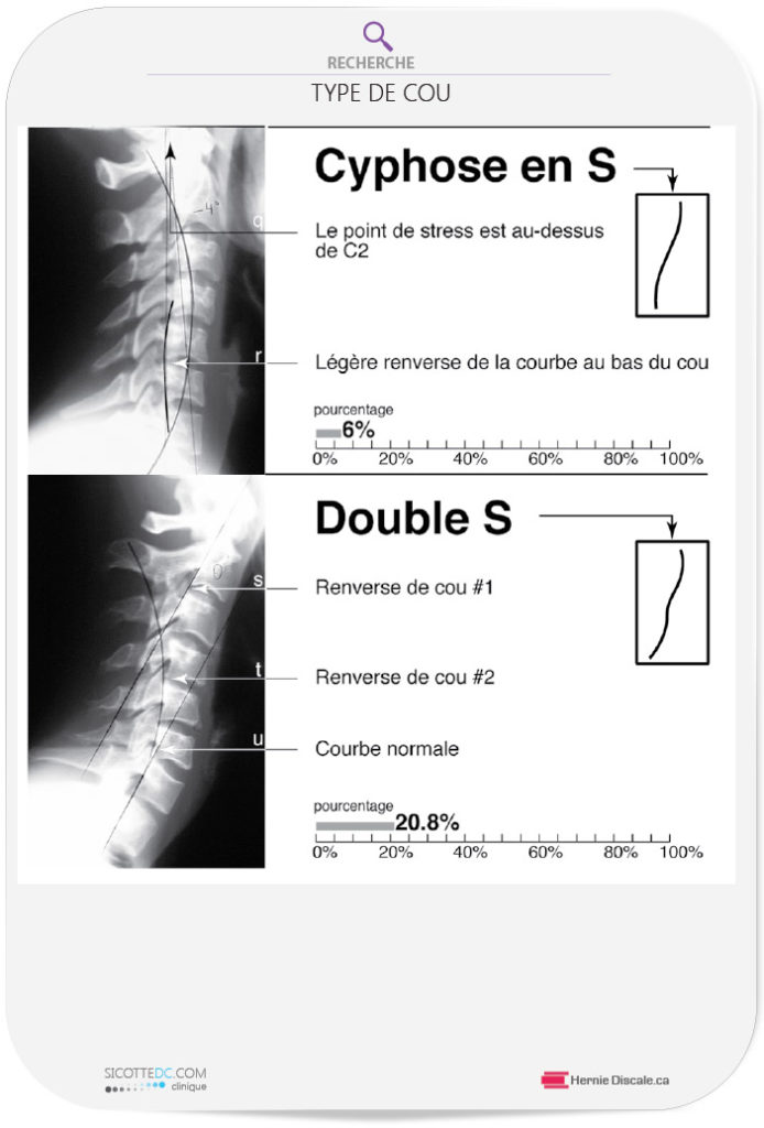 Mauvaise Posture du Cou Relation Entre la Courbure et la Douleur Mauvaise Posture du Cou Relation Entre la Courbure et la Douleur